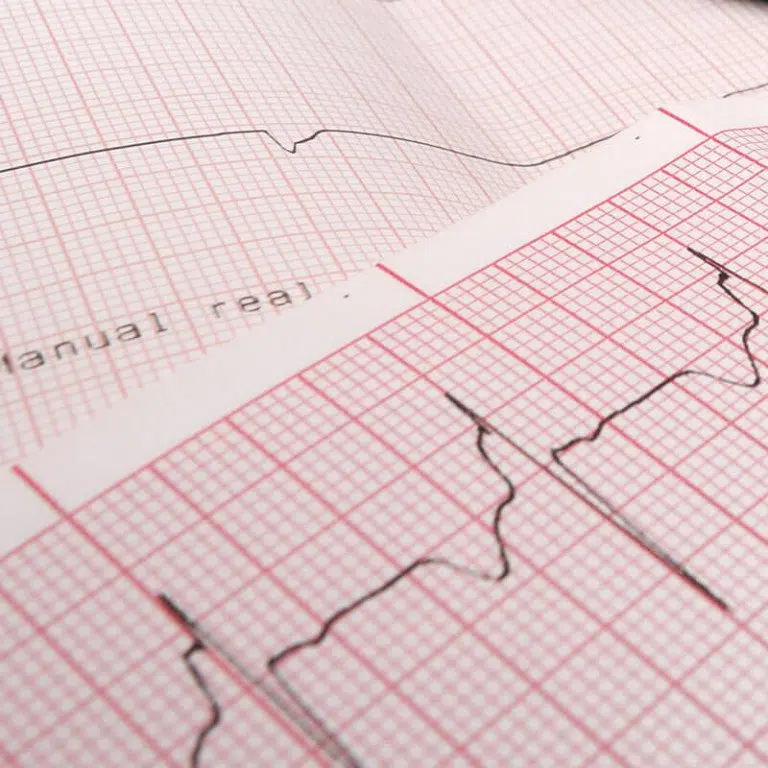 ecg-paper-101-everything-you-need-to-know-about-ecg-paper-panda